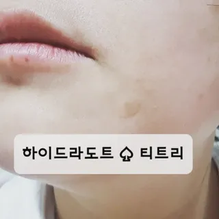 올리브영 엘라밴드 하이드로 도트 스팟패치 12mm, 티트리 — 4점을 준 리뷰어가 2022년 9월 올린 사용 사진