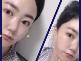 아이디플라코스메틱 아이디 페이스핏 마이너스 밴드 v2 — 4.5점을 준 리뷰어가 2022년 5월 올린 사용 사진