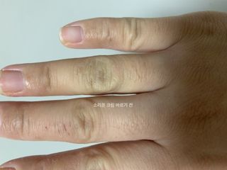 건선/아토/습진/민감성 피부 천연보습진정크림 소리온 크림 & 센시티브 크림 50g — 5점을 준 리뷰어가 2022년 1월 올린 사용 사진