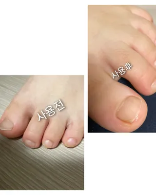 유케어 YOU CARE 문제성 손발톱케어_럭키풋 — 5점을 준 리뷰어가 2022년 10월 올린 사용 사진