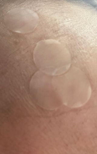 3M 넥스케어 블레미쉬 여드름패치 릴리프 111매(짜기 전 케어) +알코올스왑 증정 — 5점을 준 리뷰어가 2024년 7월 올린 사용 사진
