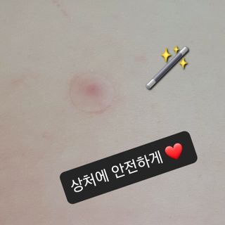 [큐어반H 스팟] 자외선 99프로 차단되는 스틱타입 스팟밴드(1팩 / 66매입) — 5점을 준 리뷰어가 2022년 12월 올린 사용 사진