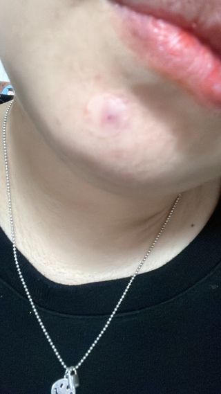 [큐어반H 스팟] 자외선 99프로 차단되는 스틱타입 스팟밴드(1팩 / 66매입) — 4.5점을 준 리뷰어가 2022년 11월 올린 사용 사진