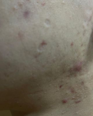 닥터플리너스 제트 큐어 크림 30ml + 제로 트러블 패치 9EA — 3점을 준 리뷰어가 2022년 4월 올린 사용 사진